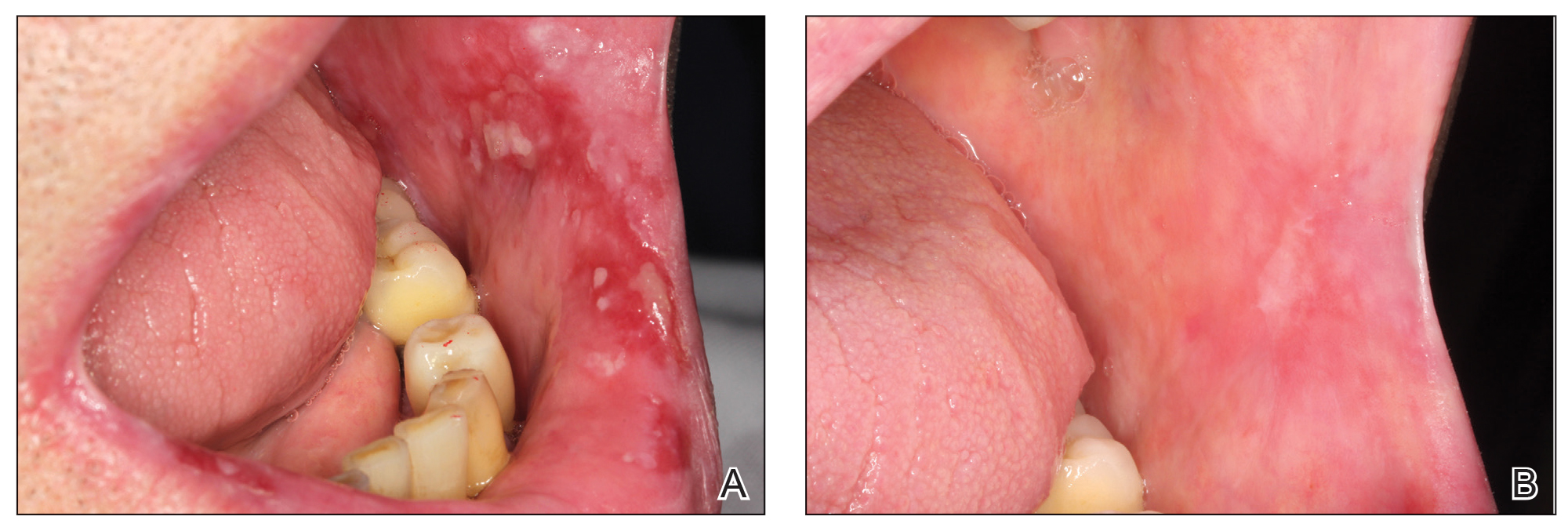 Oral Lichen Planus Treated With Plasma Rich In Growth Factors Mdedge Dermatology